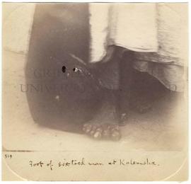 [519] Foot of six-toed man at Kalemsha.